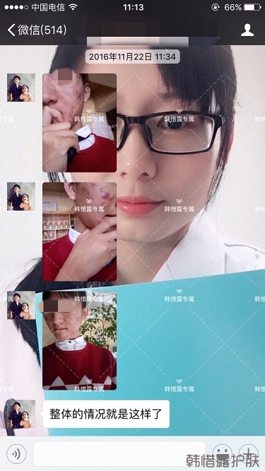 臉上長痘痘怎么去掉？徹底告別痘痘，自卑到自信的蛻變！