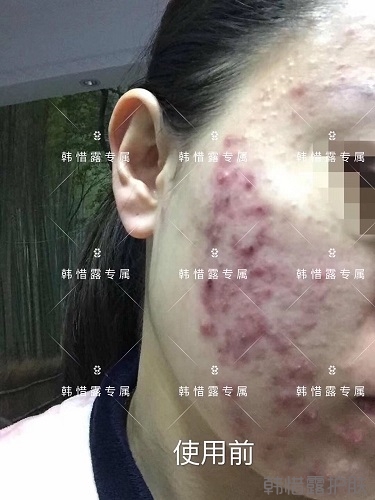 膿包痘痘好了，從慘不忍睹到變美變漂亮