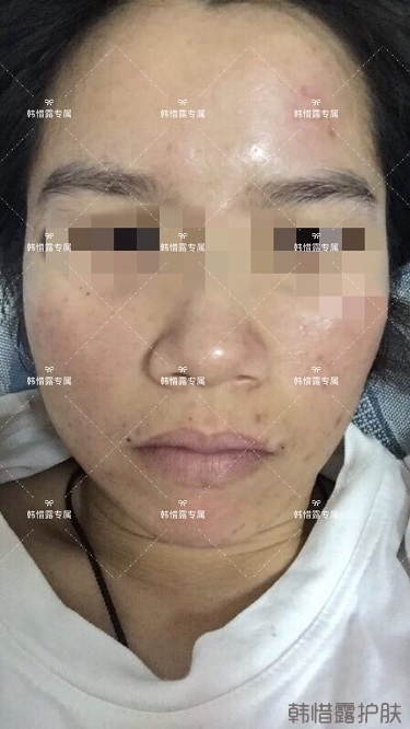 膿包痘祛痘效果,擁有干凈的臉不等待!