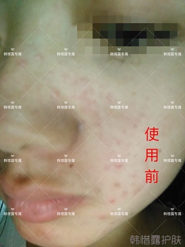 額頭長痘臉頰長痘痘粉刺,這樣調理幫你恢復嫩白肌膚!