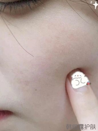 反復長痘這么多年,你需要找準痘因?