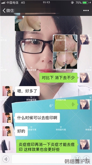 痘痘好多了，認真聽話按照要求使用，每個人都可以變很美！