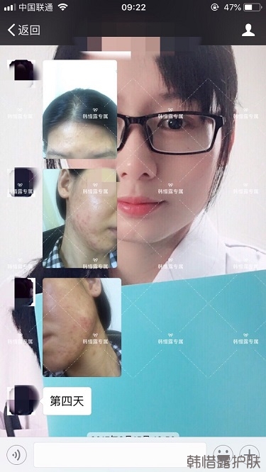 激素臉滿臉粉刺痘痘到光滑健康肌膚的蛻變