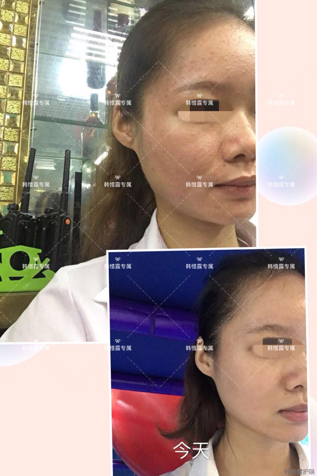 閉口粉刺怎么去除?嚴格按要求使用，粉刺效果不錯！