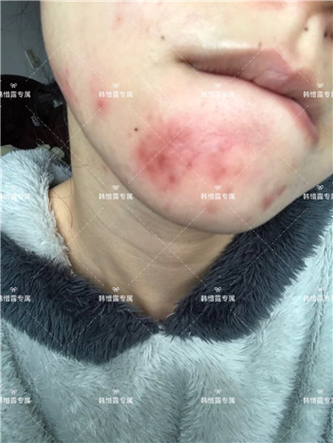 【視頻】臉上長粉刺怎樣去掉？醫(yī)院都沒搞定韓惜露幫我搞定了，超級開心！