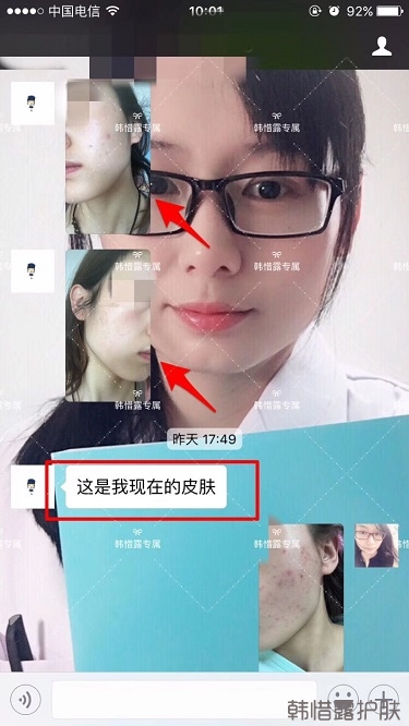 痘痘好了皮膚美麗，不想再記起曾經滿臉痘痘的自己！