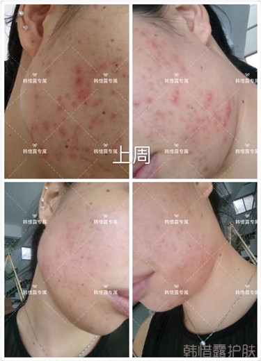 痘痘好多了，認真聽話按照要求使用，每個人都可以變很美！