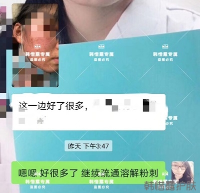 臉上長(zhǎng)閉口粉刺怎么去除,粉刺消下去了,皮膚變好了