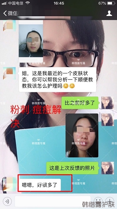 額頭長痘臉頰長痘痘粉刺,這樣調理幫你恢復嫩白肌膚!