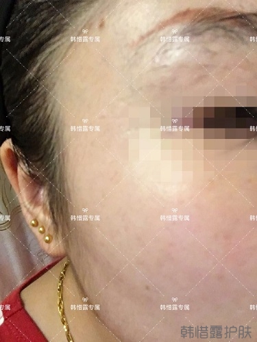 下巴長痘怎么辦？看這里徹底去掉痘痘，不再長痘了！