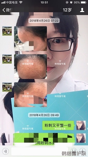 粉刺怎么辦？粉刺去除反饋：不要被粉刺遮住光潔的額頭