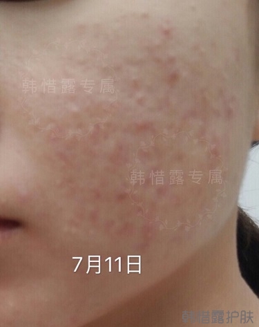 去粉刺效果，單用粉刺膏與祛痘霜也能快快溶解粉刺！