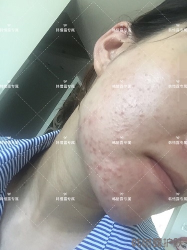 粉刺痘痘，痘印都沒了，寶媽重回顏值巔峰！