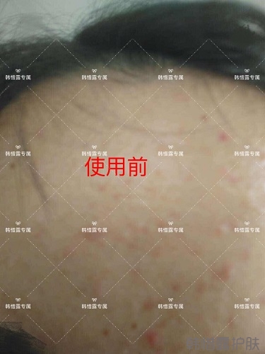 額頭長痘臉頰長痘痘粉刺,這樣調理幫你恢復嫩白肌膚!