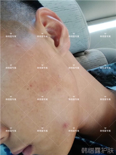 粉刺消了，皮膚光滑了，變帥氣不少呦！