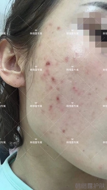 痘痘好了皮膚美麗，不想再記起曾經滿臉痘痘的自己！