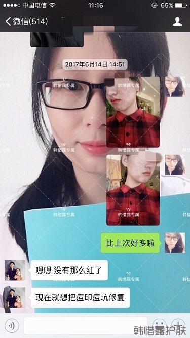 臉上長痘痘怎么去掉？徹底告別痘痘，自卑到自信的蛻變！