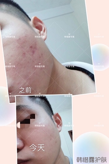 粉刺、痘痘、痘印、統(tǒng)統(tǒng)解決啦！祛痘去粉刺就是這么簡(jiǎn)單！