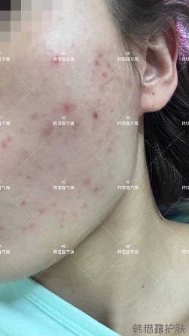 痘痘好了皮膚美麗，不想再記起曾經滿臉痘痘的自己！