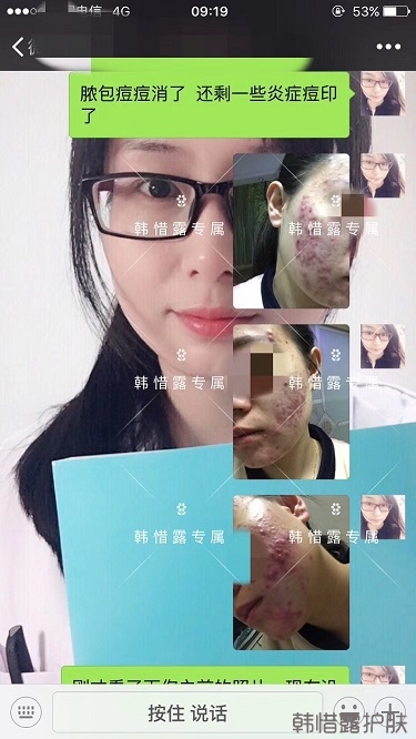 膿包痘痘好了，從慘不忍睹到變美變漂亮