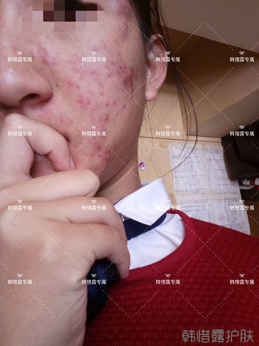 臉上長痘痘怎么去掉？徹底告別痘痘，自卑到自信的蛻變！