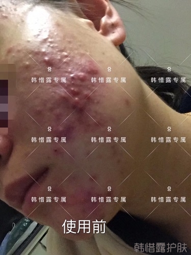 膿包痘痘好了，從慘不忍睹到變美變漂亮