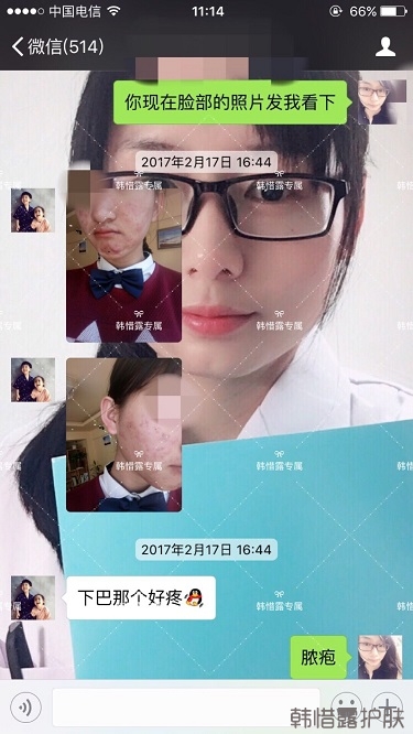 臉上長痘痘怎么去掉？徹底告別痘痘，自卑到自信的蛻變！