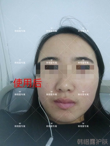 額頭長痘臉頰長痘痘粉刺,這樣調理幫你恢復嫩白肌膚!