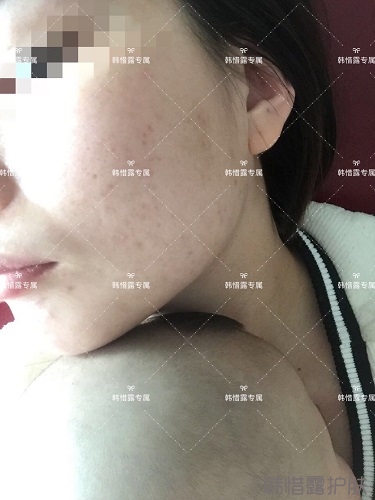 粉刺痘痘，痘印都沒了，寶媽重回顏值巔峰！