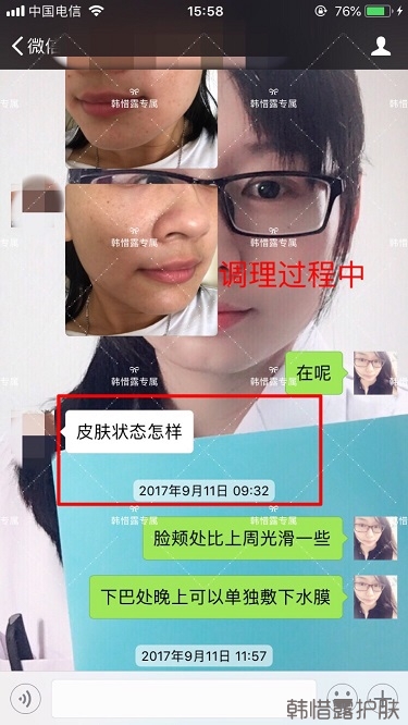 粉刺密密麻麻，試過很多方法無果后找韓惜露老師輕松去掉粉刺！