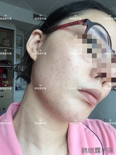 粉刺痘痘，痘印都沒了，寶媽重回顏值巔峰！