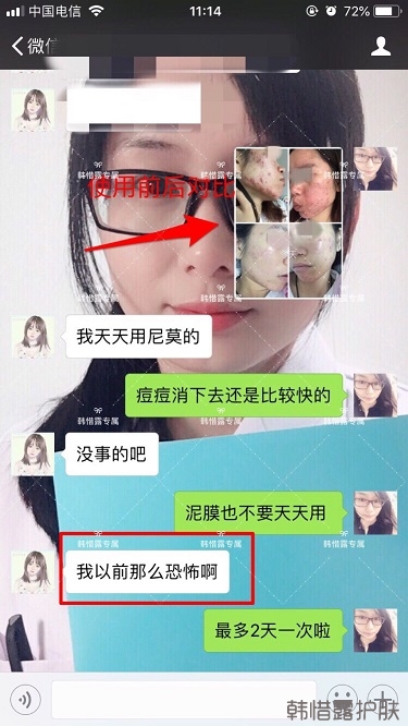 膿包痘祛痘效果,擁有干凈的臉不等待!