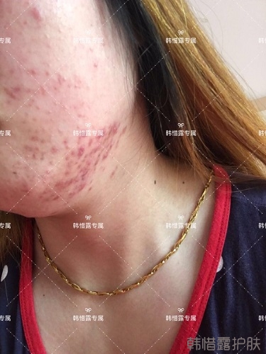 下巴長痘怎么辦？看這里徹底去掉痘痘，不再長痘了！