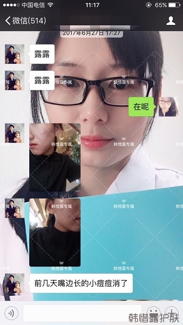 臉上長痘痘怎么去掉？徹底告別痘痘，自卑到自信的蛻變！