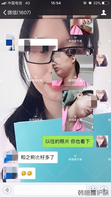 粉刺痘痘，痘印都沒了，寶媽重回顏值巔峰！