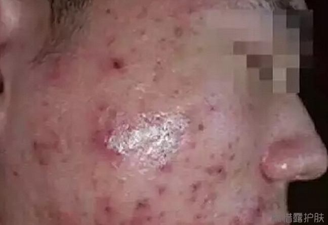 用祛痘產品爆痘正常嗎