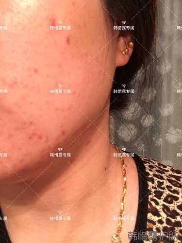 下巴長痘怎么辦？看這里徹底去掉痘痘，不再長痘了！