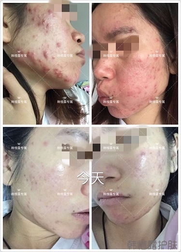 膿包痘祛痘效果,擁有干凈的臉不等待!