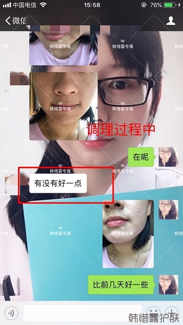 粉刺密密麻麻，試過很多方法無果后找韓惜露老師輕松去掉粉刺！