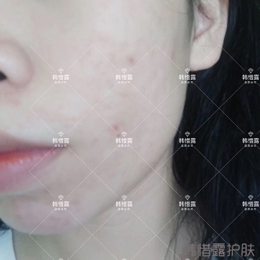 祛痘后判若兩人，膿包痘消了變小仙女