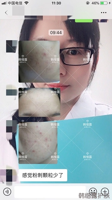 去粉刺效果，單用粉刺膏與祛痘霜也能快快溶解粉刺！