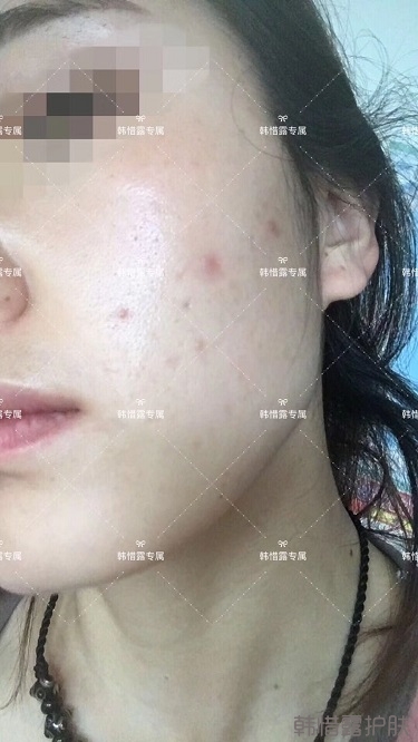 痘痘好了皮膚美麗，不想再記起曾經滿臉痘痘的自己！