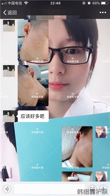 粉刺消了，皮膚光滑了，變帥氣不少呦！