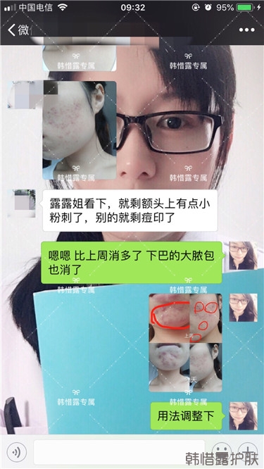 粉刺只剩一點(diǎn)點(diǎn)了，敏感肌粉刺修復(fù)，更美麗！