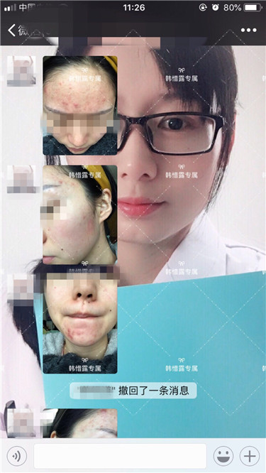 【視頻】臉上長粉刺怎樣去掉？醫(yī)院都沒搞定韓惜露幫我搞定了，超級開心！