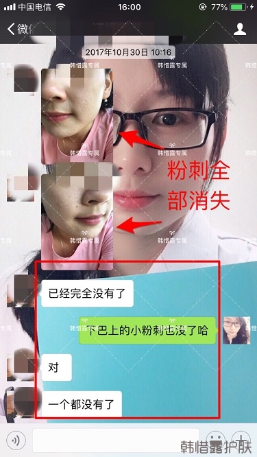 粉刺密密麻麻，試過很多方法無果后找韓惜露老師輕松去掉粉刺！