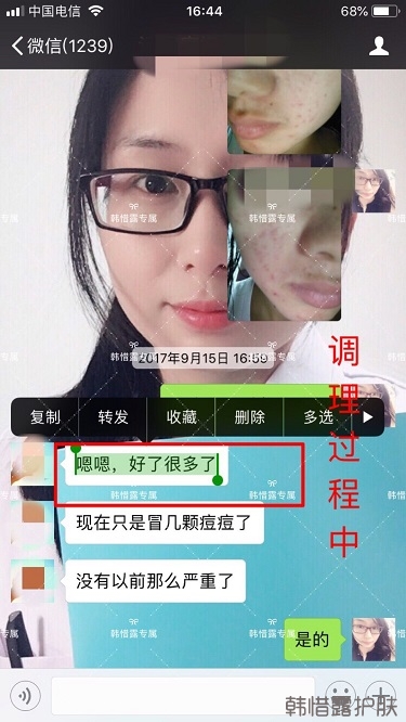 額頭長痘臉頰長痘痘粉刺,這樣調理幫你恢復嫩白肌膚!