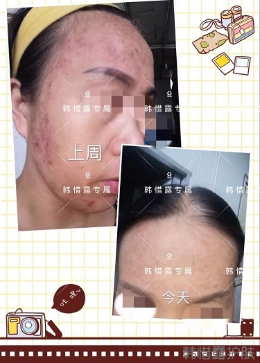 多年的粉刺痘痘,沒想到使用一周后粉刺消了這么多!