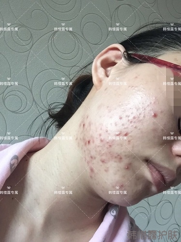 粉刺痘痘，痘印都沒了，寶媽重回顏值巔峰！