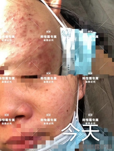 臉上長(zhǎng)閉口粉刺怎么去除,粉刺消下去了,皮膚變好了